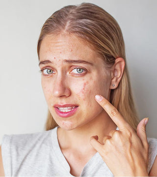 6 cosas que pueden hacer más graves los brotes de acné.